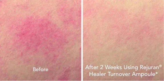 Rejuran Turnover Ampoule c-PDRN 0.5% 30ml