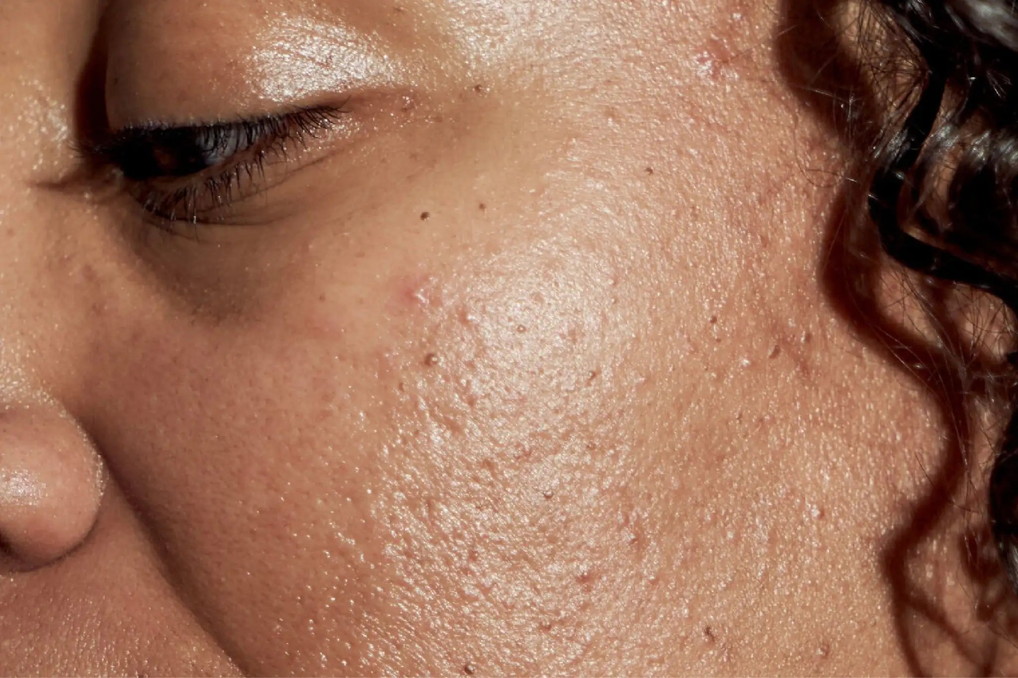 ACNE / BREAKOUTS / OILY SKIN