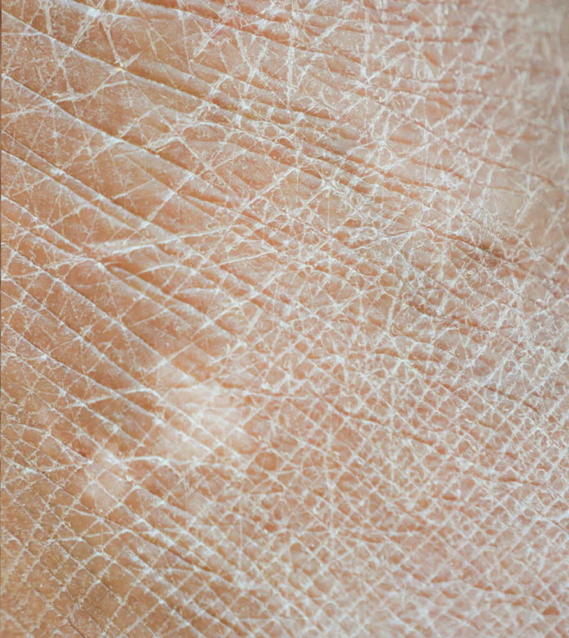 DRY / DEHYDRATED SKIN