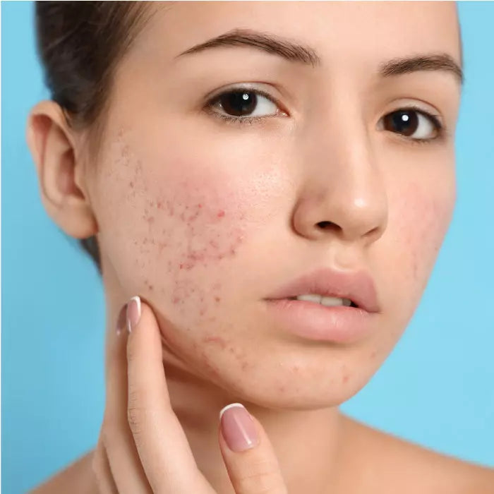 ACNE / BREAKOUTS / OILY SKIN