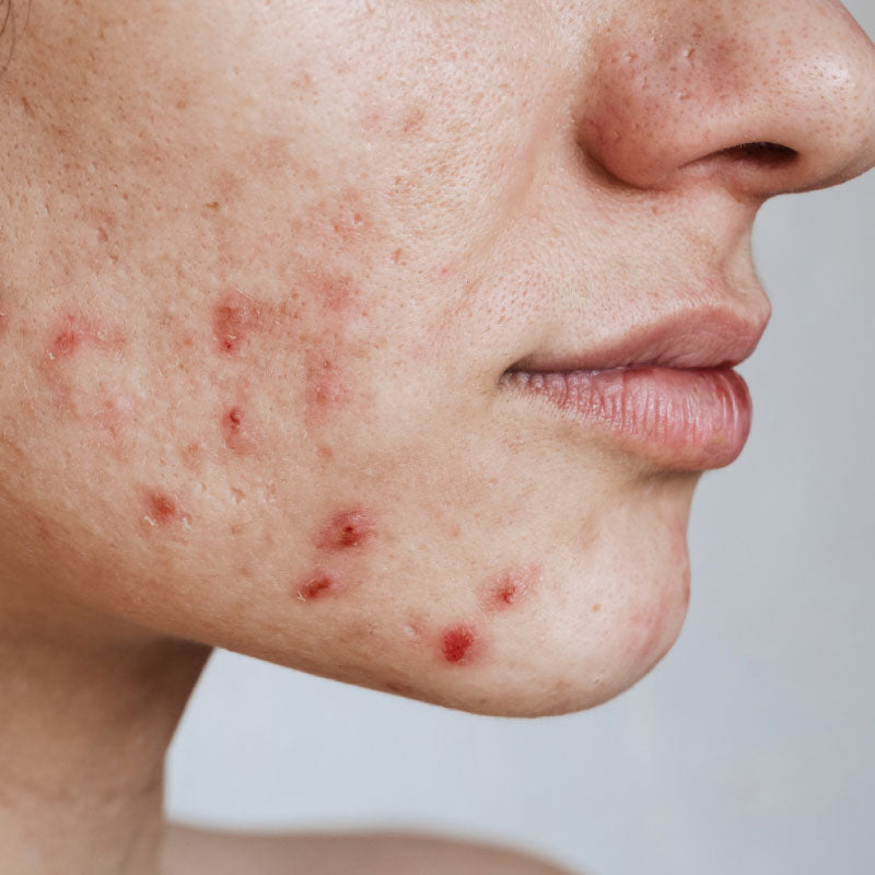 ACNE SCARS / TEXTURE / POST-ACNE MARKS