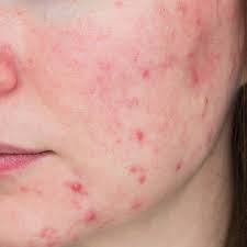 ROSACEA / REDNESS / DAMAGED BARRIER