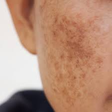 HYPERPIGMENTATION / MELASMA / DARK SPOTS