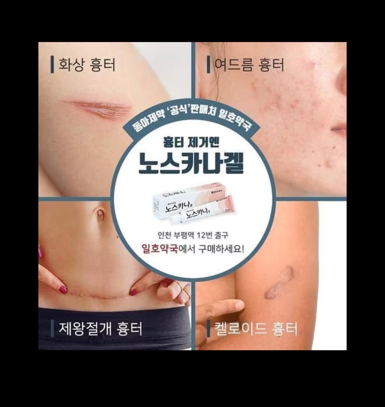 NOSCARNA Scar Gel Treat Keloid, Surgical & Acne Scars 20g